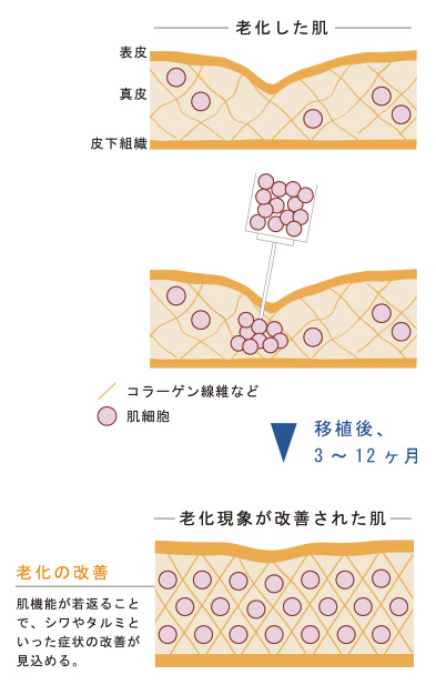 肌細胞移植